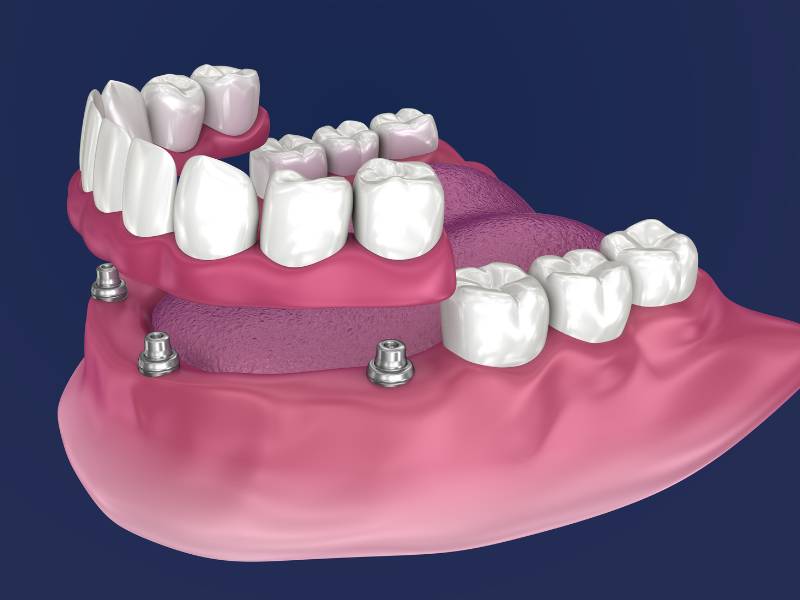 Example of a partial snap-on denture