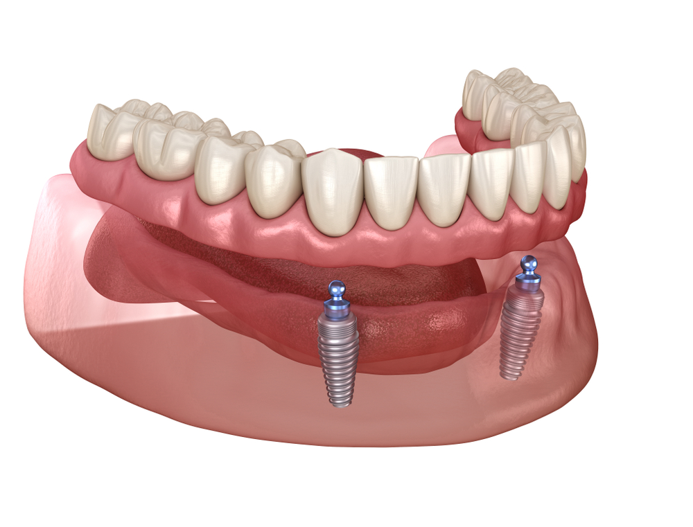 An example of all on 4 dental implants
