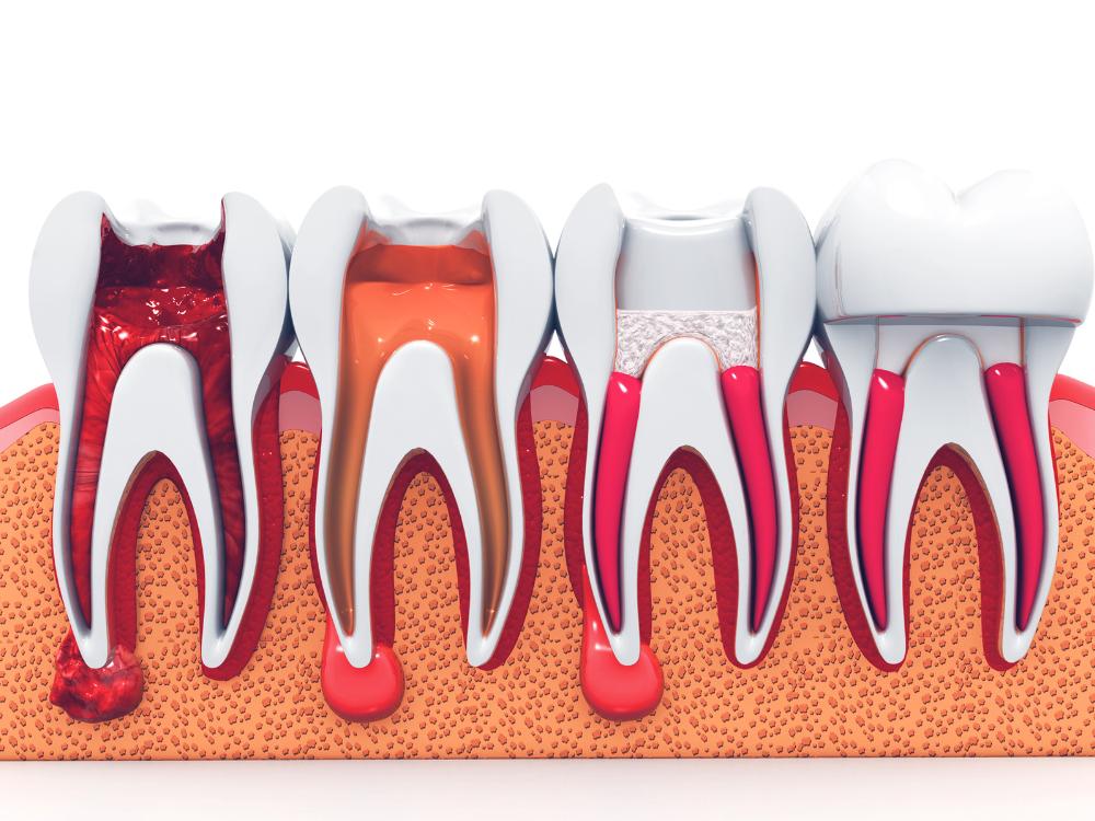 Example of how a root canal works